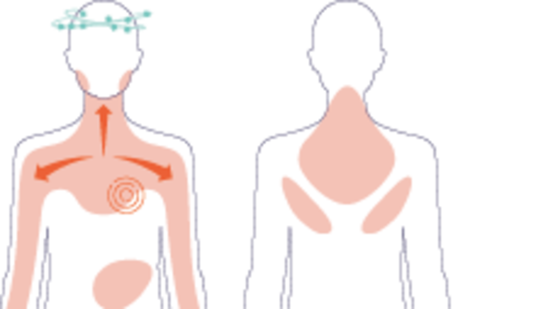 Diagramm einer Person mit hervorgehobenen Schmerzbereichen auf der Vorderseite (Kopf, Brust, Bauch, Nacken, Schultern) und Rückseite (Nacken, Schultern, oberer Rücken) des Körpers.