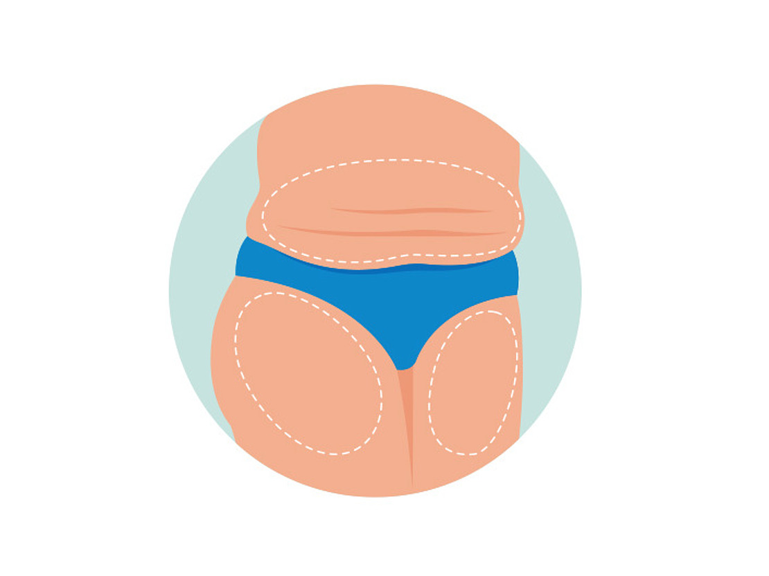 Abbildung eines Körpers mit umrissenen Bereichen an Taille, Bauch und Oberschenkeln. Die Figur trägt blaue Unterwäsche vor einem hellen Hintergrund.