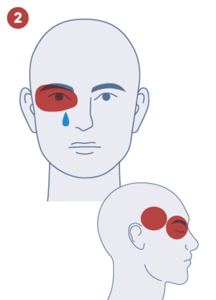 Illustration des Gesichts einer Person mit roter Schattierung um das linke Auge und einer blauen Träne darunter, die auf Schmerzen oder Unbehagen hinweist; eine Seitenansicht hebt ebenfalls den betroffenen Bereich um das Auge hervor.