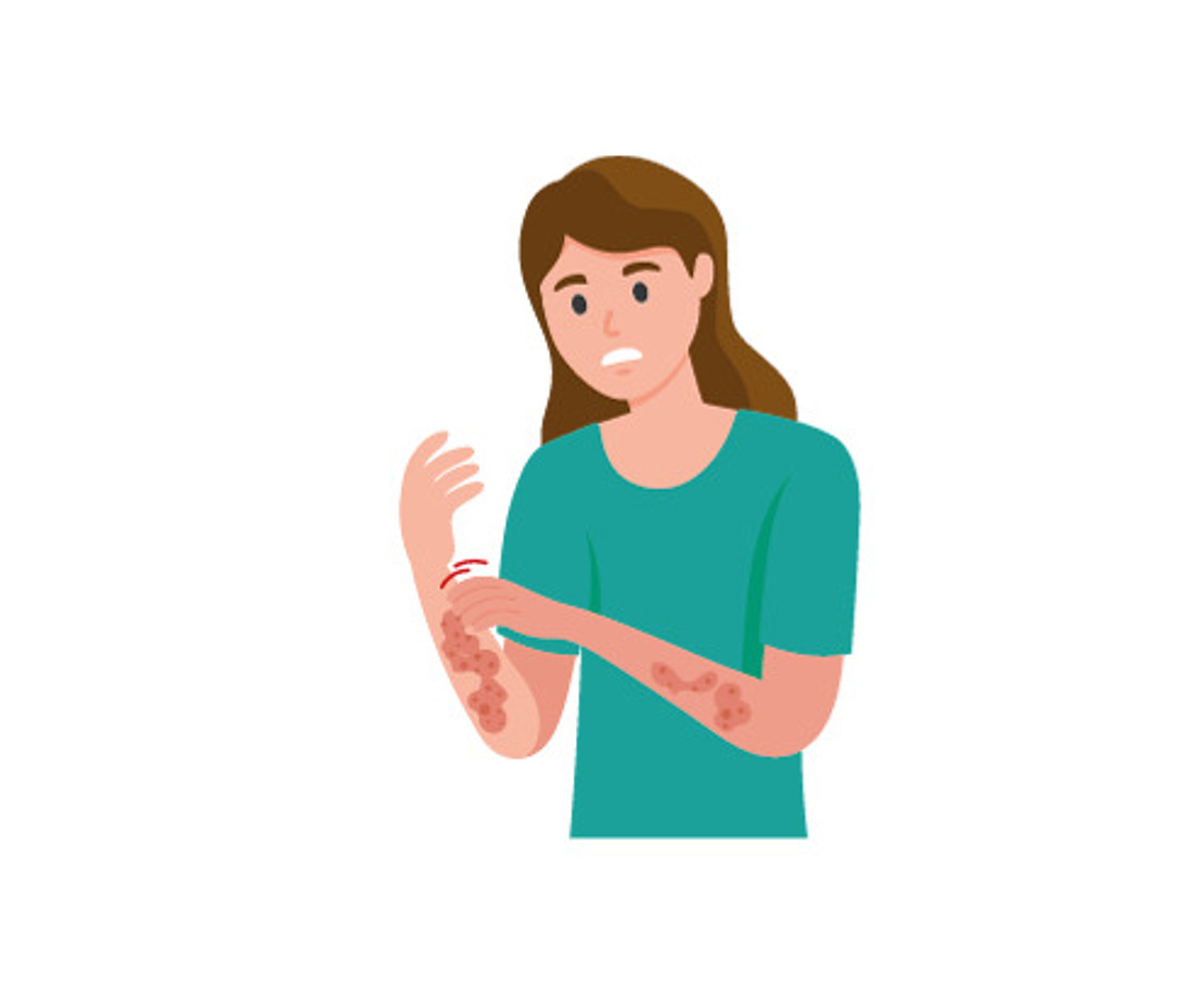 Illustration einer Frau mit braunen Haaren, die sich die rote, gereizte Haut am Arm aufkratzt und sich dabei unwohl zu fühlen scheint, was möglicherweise auf eine allergische Reaktion oder eine Hauterkrankung hinweist. Sie trägt ein blaugrünes Hemd.
