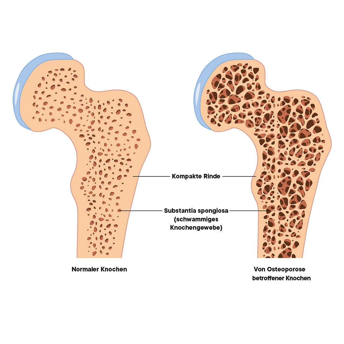 Abbildung: Vergleich eines normalen Knochens (links) mit dichter Struktur mit einem osteoporotischen Knochen (rechts) mit größeren Poren und dünnerer Struktur. Die Beschriftungen heben die Unterschiede zwischen kompaktem Knochen und spongiösem Knochengewebe hervor.