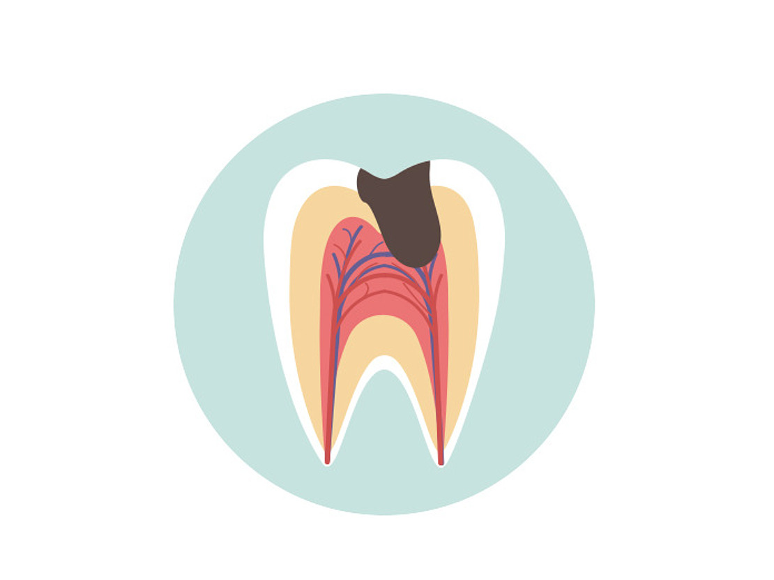 Abbildung eines Zahnquerschnitts, der die Schichten Zahnschmelz, Dentin und Pulpa zeigt. Auf der oberen Oberfläche ist ein schwarzes Loch zu sehen, das die äußere Schicht durchdringt.