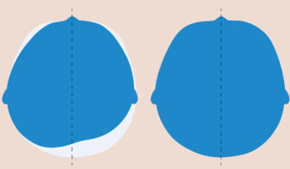 Die Illustration zeigt den Vergleich eines asymmetrischen Kopfes mit einem symmetrischen Kopf.