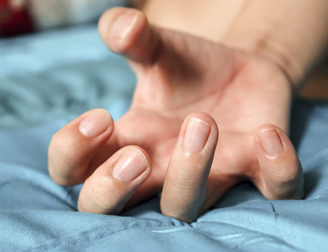 Das Bild zeigt eine krampfende Hand bei einer spastischen Lähmung.