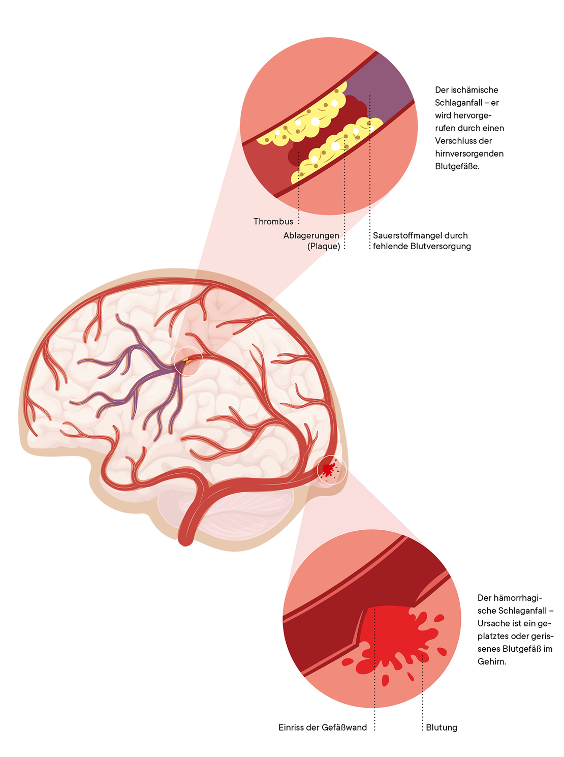 Illustration eines Gehirn mit Detailabbildungen zum ischämischen und hämorrhagischen Schlaganfall